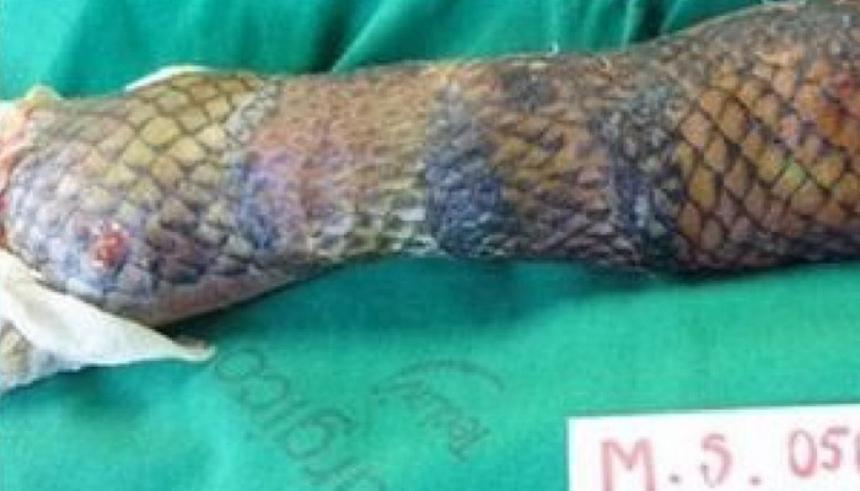 Mâna a fost învelită în piele de pește timp de 3 săptămâni.  Efectul i-a șocat pe medici